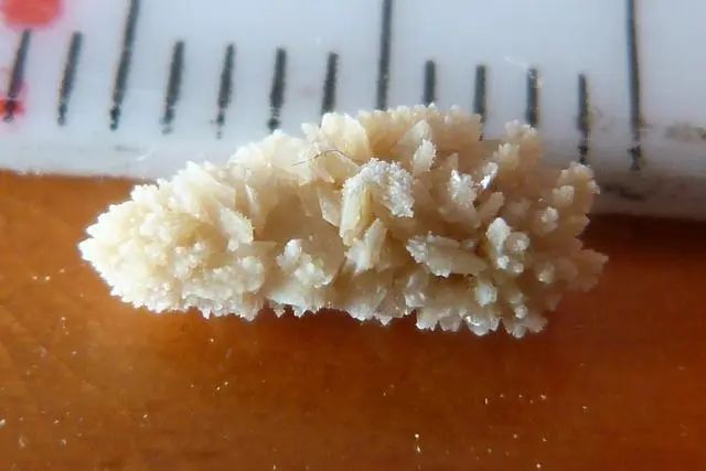 微型磁控溶石机器人可为肾结石的治疗过程大大减轻痛苦(图1)